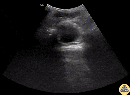 Trauma - Free Peritoneal Fluid from Splenic Injury