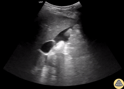 Trauma - +FAST in Morrison's Pouch from Splenic Injury