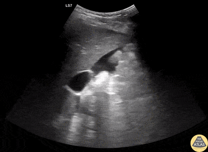 Trauma - +FAST Exam from Splenic Injury