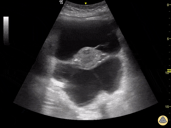 Bowel-GI - Large Volume Ascites on Transverse Pelvic View