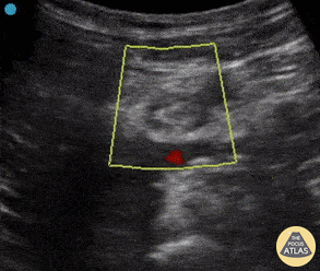 Vascular - Common Femoral DVT