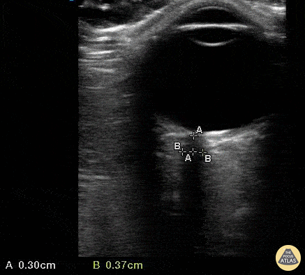 Orbital - Normal ONSD