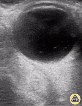 Orbital - Vitreous Hemorrhage