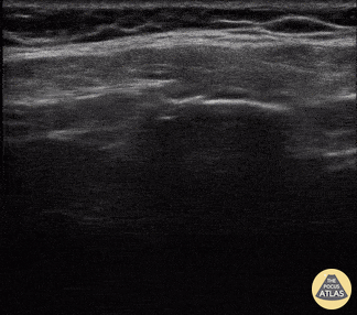 Musculoskeletal - Rib Fracture