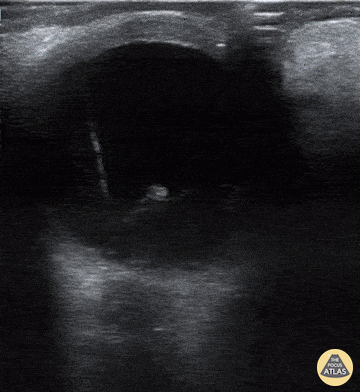 Orbital - Vitreous Hemorrhage due to Proliferative Diabetic Retinopathy