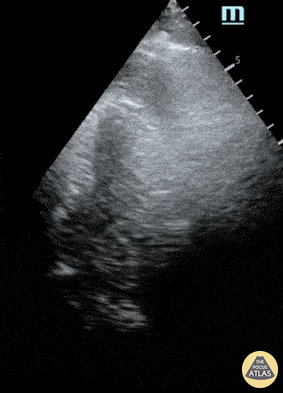 Pericardial Disease - Pericardial Effusion noted during CPR