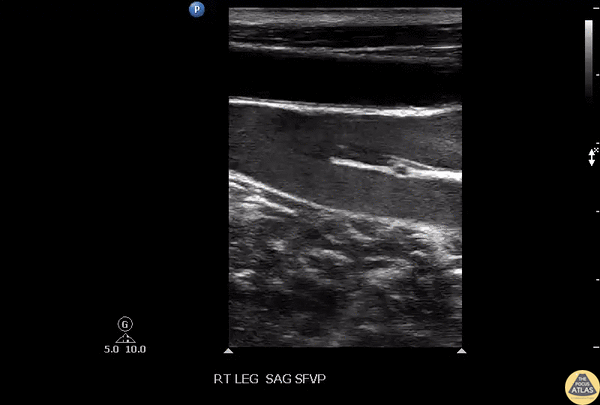 Vascular - Venous Valves