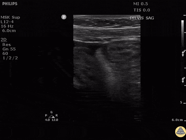 Bowel-GI - Mesenteric Vasculitis