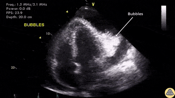 Pericardial Disease - Confirmation of Needle Placement For Pericardiocentesis