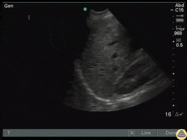 Trauma - Hepatic Laceration