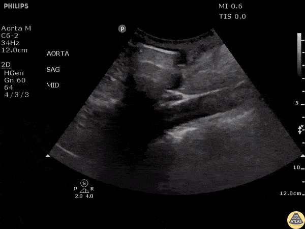 Aorta - Aortic Dissection