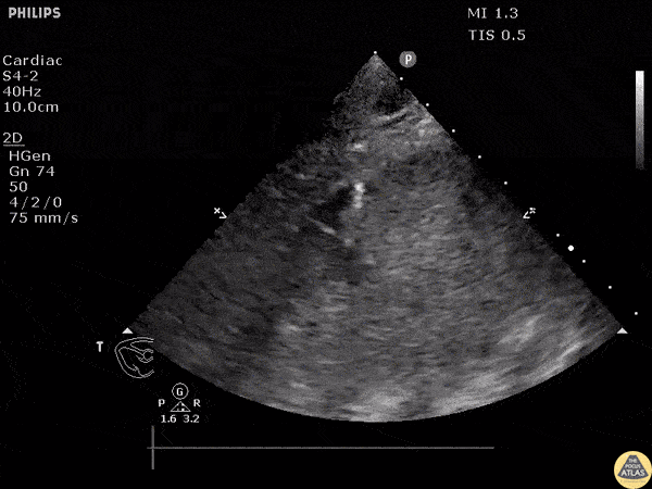 Pericardial Disease - Attempted Pericardiocentesis