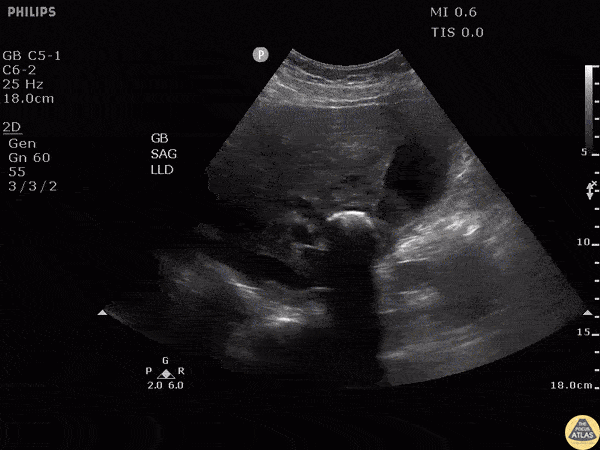 Biliary - Gallstone in Neck Causing Mirizzi's Syndrome