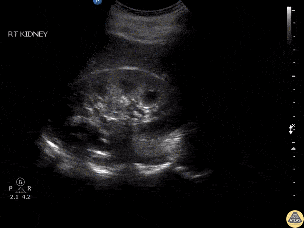 Renal/GU - Medullary Pyramids