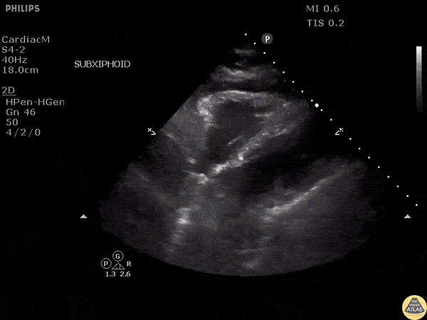 Other Cardiac Pathology - Pacer Wire Perforation