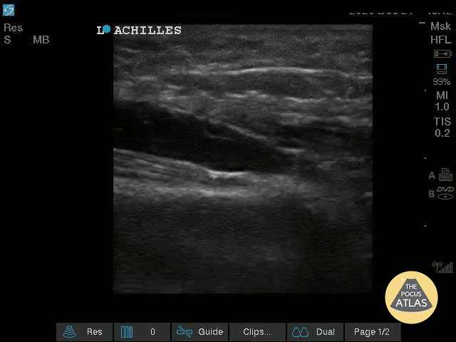 Musculoskeletal - Nearly Complete Achilles Tear