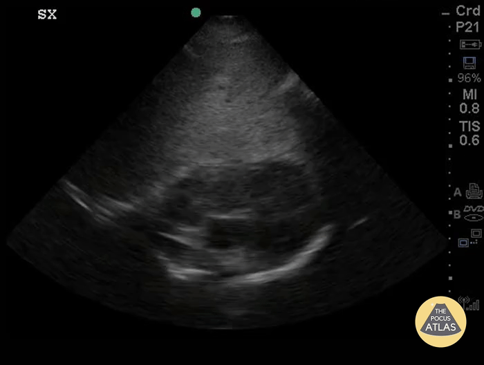 Cardiac Tumors - Cavo-Atrial Tumor-Thrombus Complex