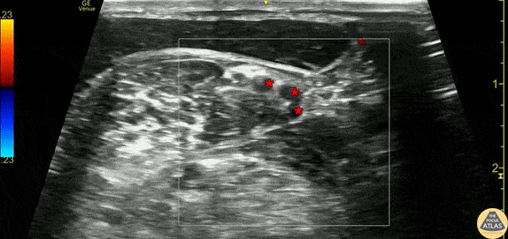 Nerve Block Gallery - Interscalene Nerve Root Anatomy