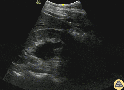 Renal/GU - Moderate Hydronephrosis