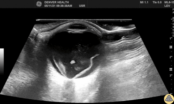 Orbital - Retinal Detachment