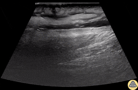 Soft Tissue - Group A Strep Necrotizing Fasciitis