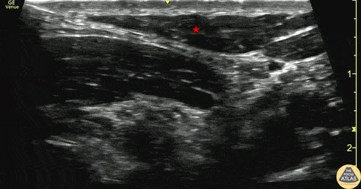 Nerve Block Gallery - Superficial Cervical Plexus Block for Clavicle Fracture