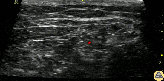 Nerve Block Gallery - Popliteal Sciatic Nerve Block