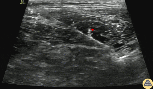 Nerve Block Gallery - Fascia Iliaca Block for Subtrochanteric Femur Fracture