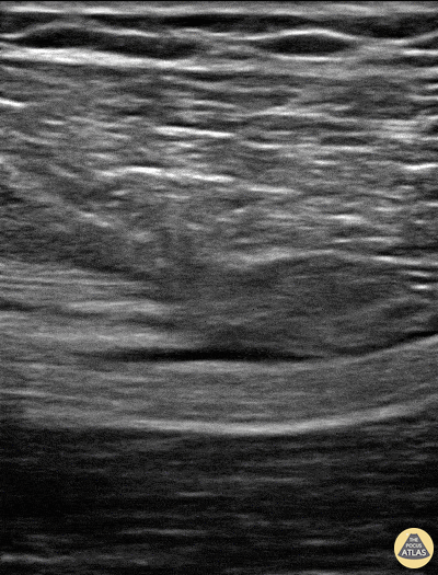 Musculoskeletal - Sciatic Nerve Hematoma
