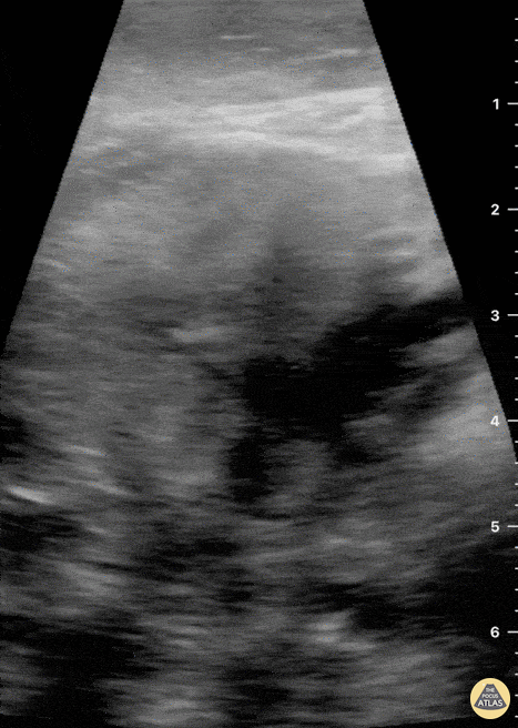 Soft Tissue - Submandibular Gland Fragmentation