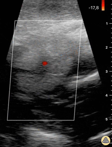 Soft Tissue - Blunt Neck Trauma (doppler)
