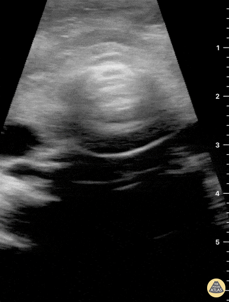 Soft Tissue - Not your classic blunt neck trauma: Case