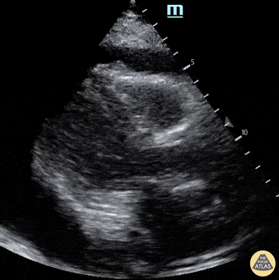 Pericardial Disease - Cardiac Tamponade