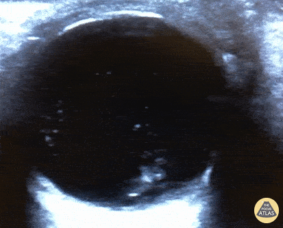 Orbital - Retinal Detachment