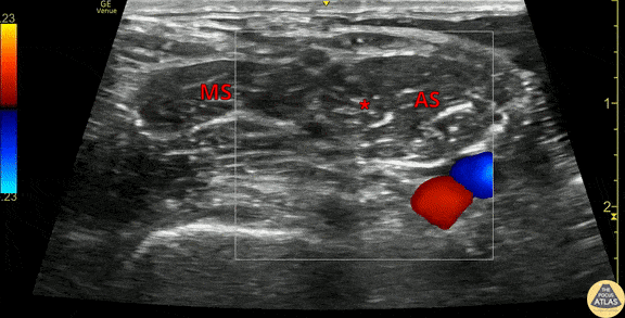 Nerve Block Gallery - Interscalene Anatomy
