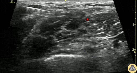 Nerve Block Gallery - Interscalene