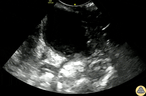 Soft Tissue - Peritonsillar Abscess