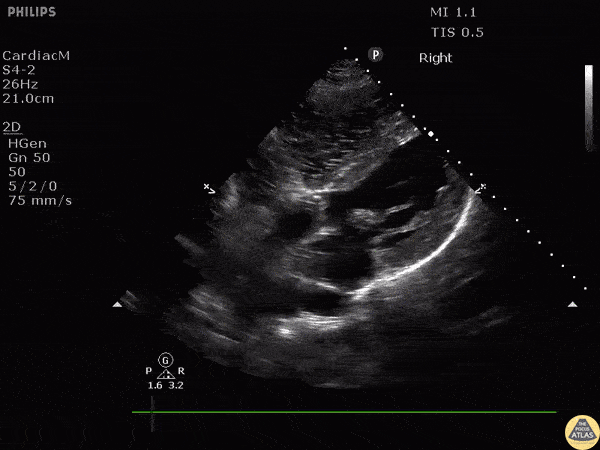 Left Ventricular Dysfunction - Ventricular Fibrillation