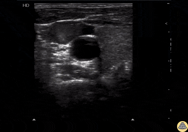 Vascular - Spontaneous Echo Contrast