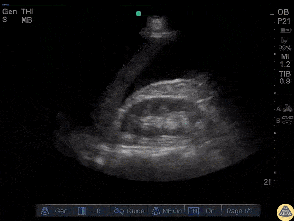 Trauma - RUQ Free Fluid