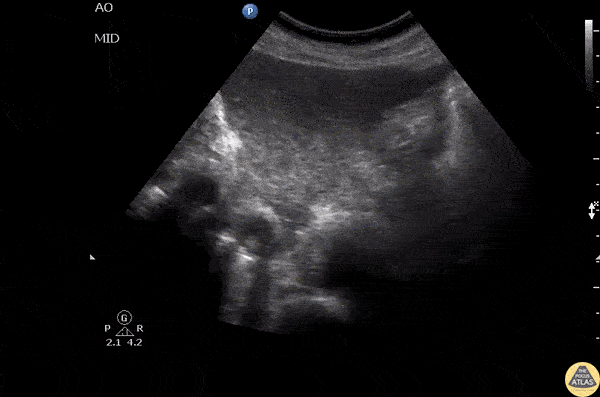 Vascular - IVC Thrombus