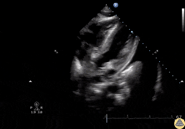 Pericardial Disease - Ascitic Fluid on Subcostal View