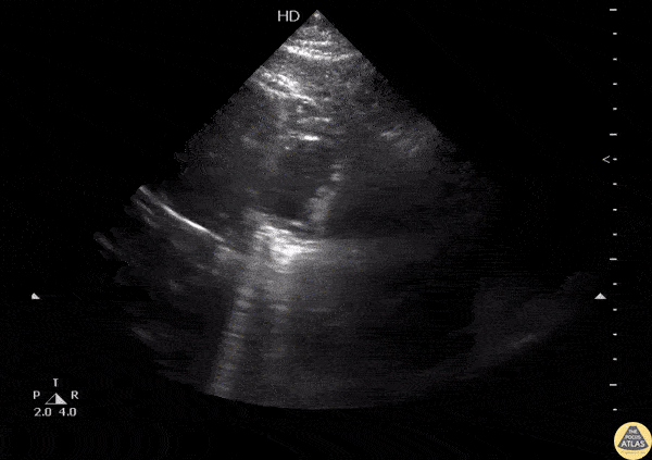 Pericardial Disease - Pericardial Cyst