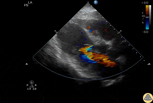 EA Echo Examples - Post-MI VSD