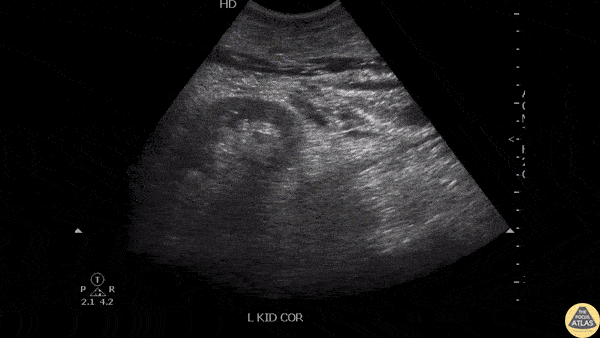 Renal/GU - Ureteral Erosion