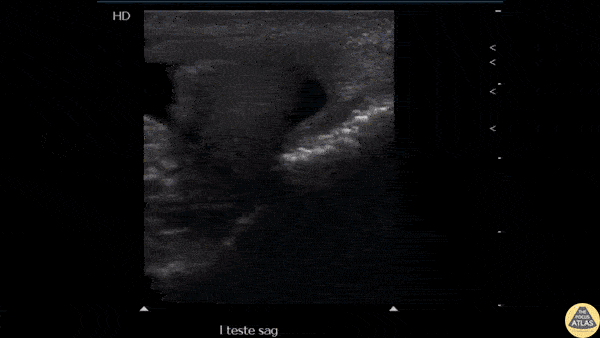 Renal/GU - Testicular Microlithiasis