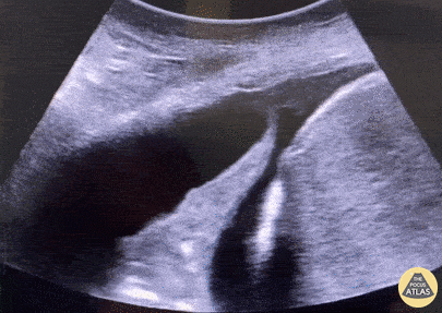 Pulmonary - Parapneumonic Effusion