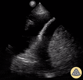 Pulmonary - Large Pleural Effusion