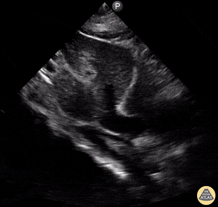 Pulmonary - Pericardial & Pleural Effusions