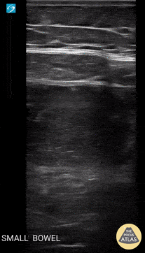 Bowel-GI - Small Bowel Obstruction